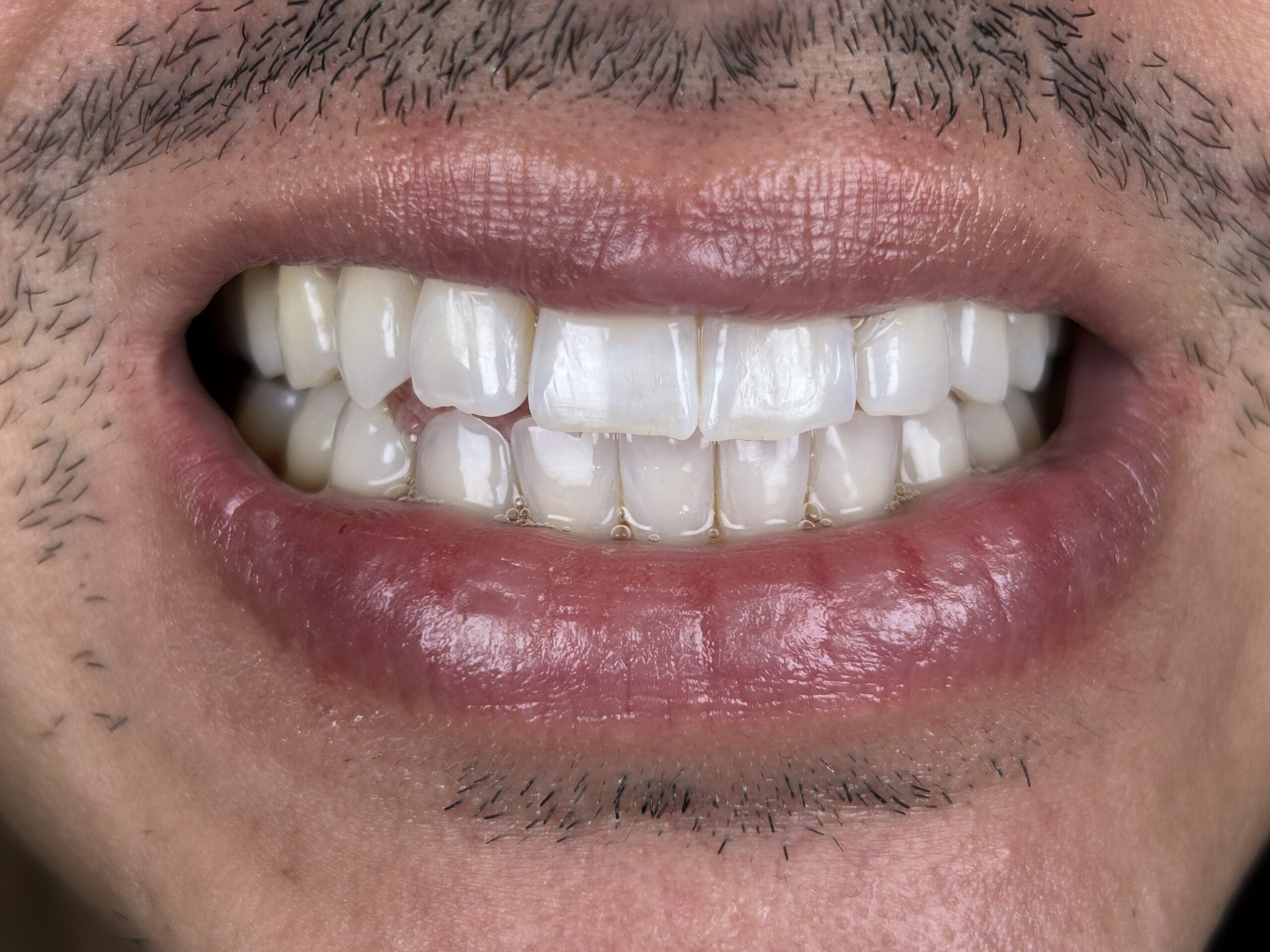 Invisalign: Your Complete Guide to a Straighter Smile at Alora Dental ...